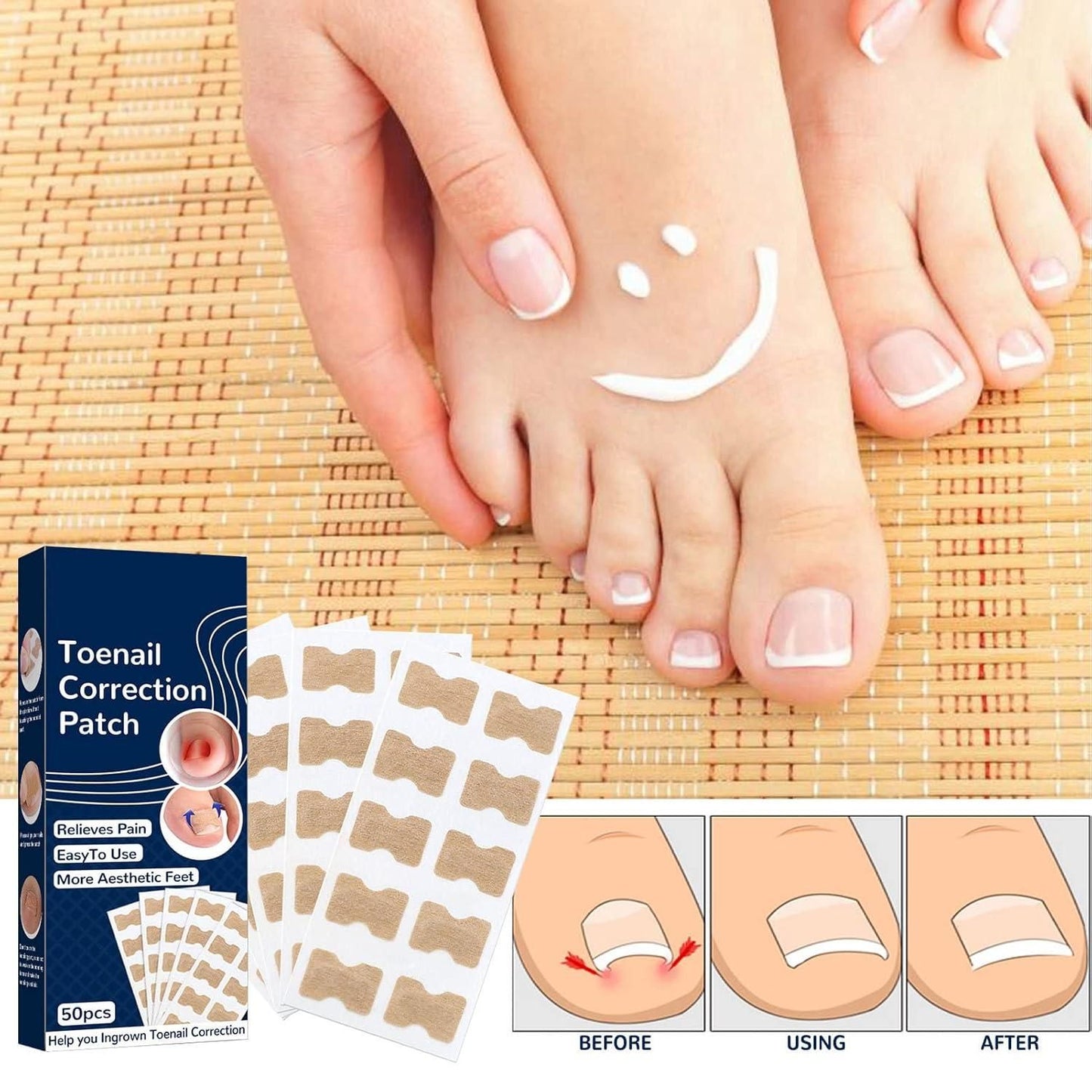 Ingrown Toenail Corrector Stickers